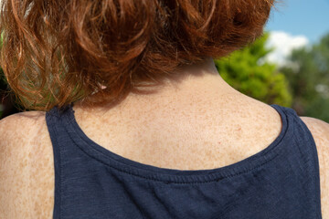 Freckled skin on upper back and shoulder of fair-skinned red-haired woman
