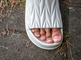 damaged toe skin from wearing thick rubber sandals