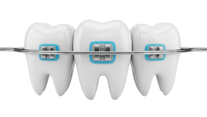 Dental Braces on Teeth