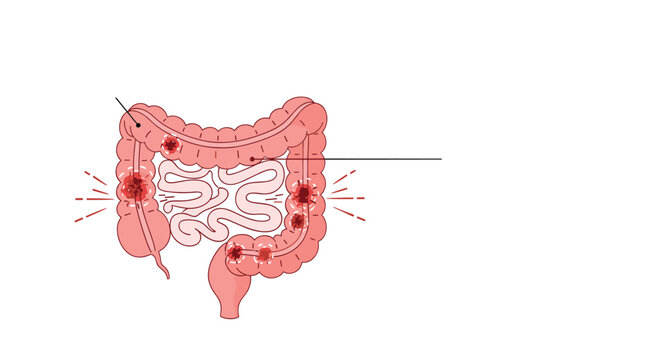 Medical vector illustration of the human large intestine showing inflammation, polyps, or signs of colorectal cancer disease.