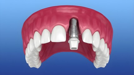 Digital Illustration of Upper Jaw Dental Implant with Abutment and Surrounding Gum Tissue