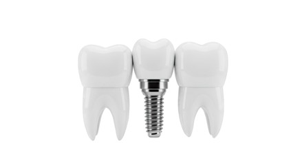 Dental Implant Between Two Teeth