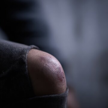 Injury concept, close-up bruised knee after accident