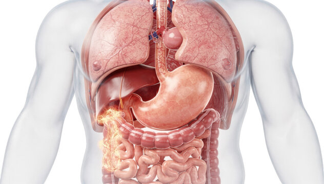 Detailed color 3D render of a hiatal hernia showing stomach pushing through the diaphragm with acid reflux impacting the esophagus on a white background.