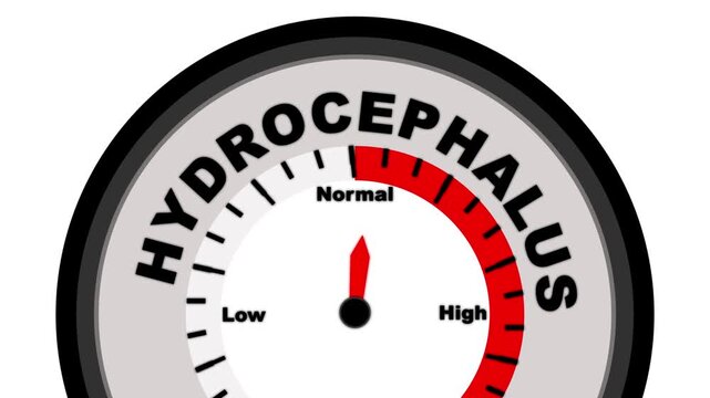 Hydrocephalus text or word shown with a barometer or tachometer-style gauge, representing varying levels of severity in the accumulation of cerebrospinal fluid in the brain and its effects on brain