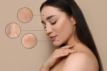 Magnified areas showing skin problems (acne, dryness). Beautiful woman on greige background