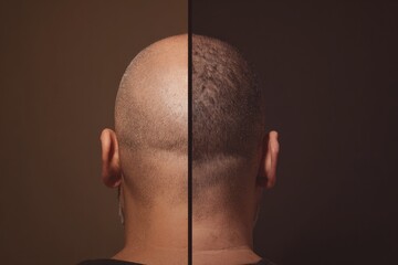 Fototapeta premium Transformation of style highlighted in a striking haircut showing the contrast between baldness and neat hair