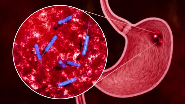 Stomach Anatomy Illustration Showing Ulcer Lesion, Digestive Fluid Interaction and Gastric Cancer Risk for Healthcare Education 3D Rendering
