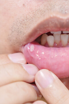 Mouth Ulcer Sore or Aphthous Stomatitis. Oral Health and Medical concepts