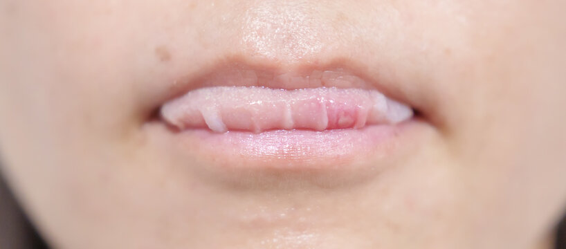 Mouth Ulcer Sore or Aphthous Stomatitis. Oral Health and Medical concepts