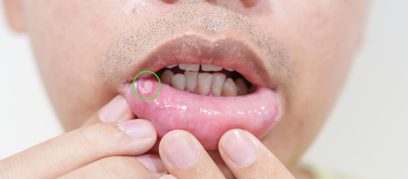 Mouth Ulcer Sore or Aphthous Stomatitis. Oral Health and Medical concepts