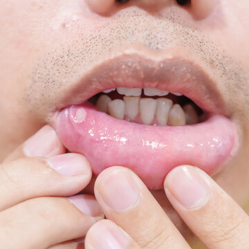 Mouth Ulcer Sore or Aphthous Stomatitis. Oral Health and Medical concepts