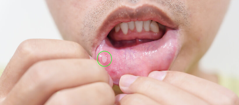 Mouth Ulcer Sore or Aphthous Stomatitis. Oral Health and Medical concepts