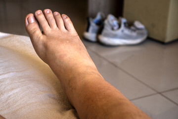 Close-up of a swollen foot and ankle showing edema, a symptom of fluid retention. Represents a medical condition, injury, or health problem related to the circulatory or lymphatic system.