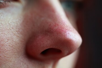 Fototapeta premium Close up of nose bridge with faint redness, cropped composition, respectful realism, illness