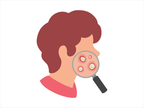 Acne Pustule in Face Skin
