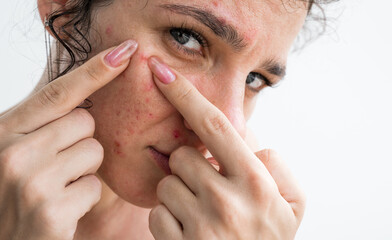 close-up portrait of adult woman face with pimples and acne. A young girl squeezes out inflamed red pimples on skin of face with fingers in close-up on a white background