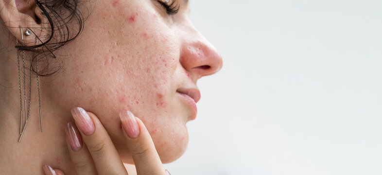portrait of teen girl with pimples and acne on problematic facial skin. Face of young female with bad red inflamed skin and acne in close-up on a white isolated background