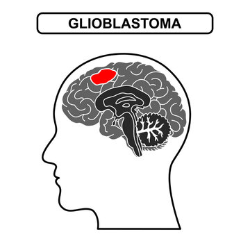 Illustration of glioblastoma . Tumor, cancer in the human brain. Illustration of brain disease. Vector nerve illustration for medical concept, poster, diagram, science or health element infographic