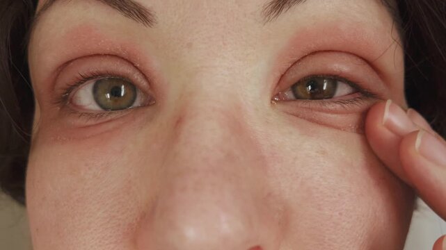 Caucasian woman scratches her inflamed dry eyelid skin. Swollen eyes with red allergic reaction. Eczema or peeling psoriasis on face skin. Dermatological disease. Beautiful female iris hetero chromia.