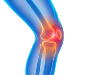 A detailed illustration of a human knee joint highlighting anatomical features and areas of potential inflammation.