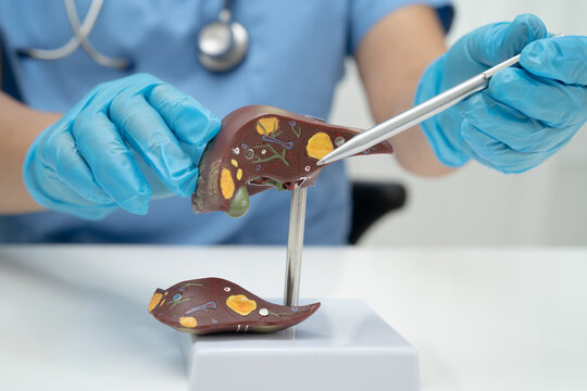 Cirrhosis, Liver cancer, fatty liver, Asian doctor with liver human anatomy model in World Hepatitis Day at hospital.
