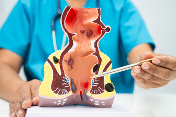 Asian doctor with rectum and hemorrhoid human anatomy model at hospital, inflamed vascular structure.