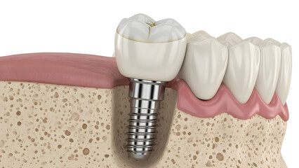 Dental Implant Illustration: A detailed, clear view of a dental implant, showcasing its placement and integration within the jawbone, signifying a pivotal advancement in oral healthcare.