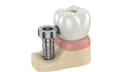 Dental Implant: A detailed view of a dental implant, showcasing the precision and artistry of modern dentistry, offers a glimpse into restorative dental care.