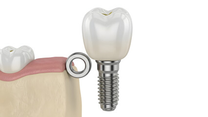 Dental Implant: A detailed view highlights a gleaming dental implant, showcasing its intricate design. Perfect for dental professionals and anyone interested in the science of dental restoration.