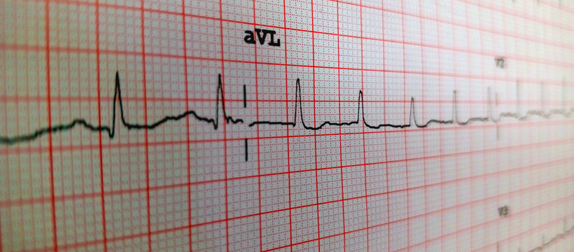 clinical ECG lead aVL rhythm strip displaying cardiac electrical activity and waveform patterns, used for cardiology diagnosis, heart monitoring, and medical education.