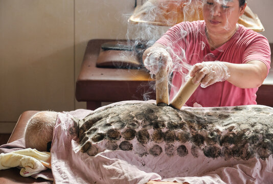 Moxibustion therapist is giving an Asian man a moxibustion treatment