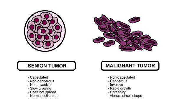 Vector illustrations of malignant and benign tumors in body tissues. Spread of cancer cells. Medical vector illustrations for education, posters, clinics, and science.