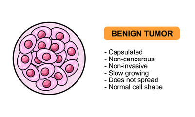 Vector Illustration of a benign tumor. Characteristics of benign tumors, non cancerous. Illustration for medical diagrma, design element, poster, or education.