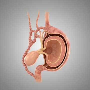 medical illustration showing a gallbladder with thickened ducts that appear "beaded" or irregular due to scarring. Realistic 3D anatomy, soft lighting, neutral background.