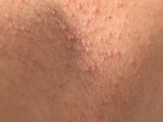 Fototapeta premium Detailed close-up of human skin showing clusters of small raised red bumps. The uneven texture highlights dermatological detail, relevant for medical, skincare, or health-related themes.