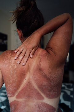Peeling Sunburned Back with Visible Tan Lines