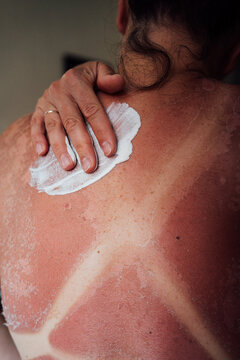 Hand Rubbing Lotion into Sunburned Skin
