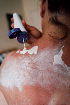 Sunscreen Lotion Applied to Burned Back
