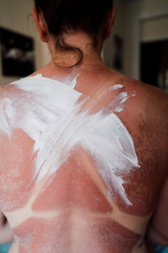 Sun Protection Application on Back During Summer Day