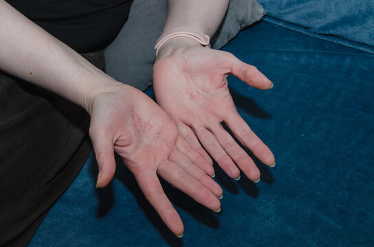 Female palm showing dyshidrotic eczema with small red itchy blisters and dry skin, close-up view of hand dermatitis symptoms. Clinical dermatological, skin issues and treatment