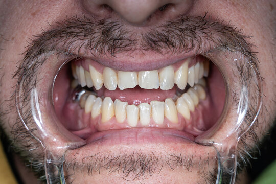 Teeth of a man. The mouth is wide open with retractors, the teeth are visible up close.