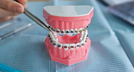 Model teeth with braces shown on a table during a dental appointment