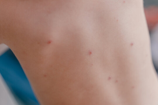 Little boy with chickenpox at home. Childhood rash. Little child with allergies, atopic dermatitis and chickenpox indoors. Close up of rashes on a child's skin - varicella zoster virus.