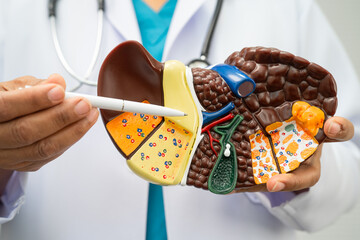Cirrhosis, Liver cancer, fatty liver, Asian woman with liver human anatomy model.