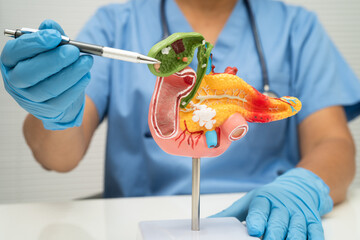 Pancreatitis, pancreatic cancer, Asian doctor with pancreas, gallbladder and bile duct human anatomy model at hospital.