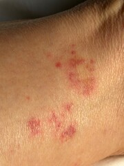 Vasculitis blood vessel inflammation on the lower leg above the ankle