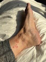 Vasculitis blood vessel inflammation on the lower leg above the ankle