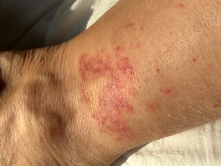 Vasculitis blood vessel inflammation on the lower leg above the ankle