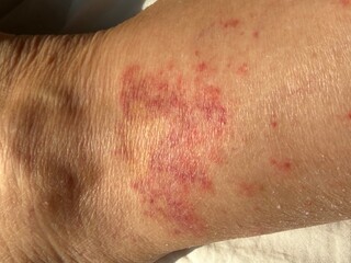 Vasculitis blood vessel inflammation on the lower leg above the ankle